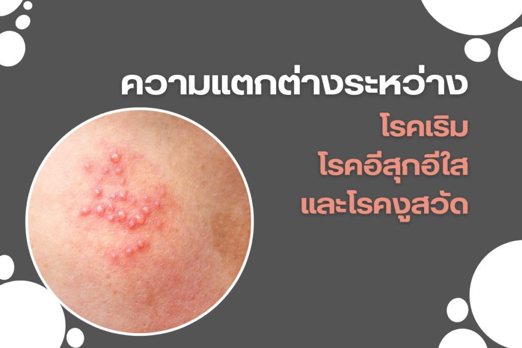 ความแตกต่างระหว่างโรคเริม โรคอีสุกอีใส และโรคงูสวัด