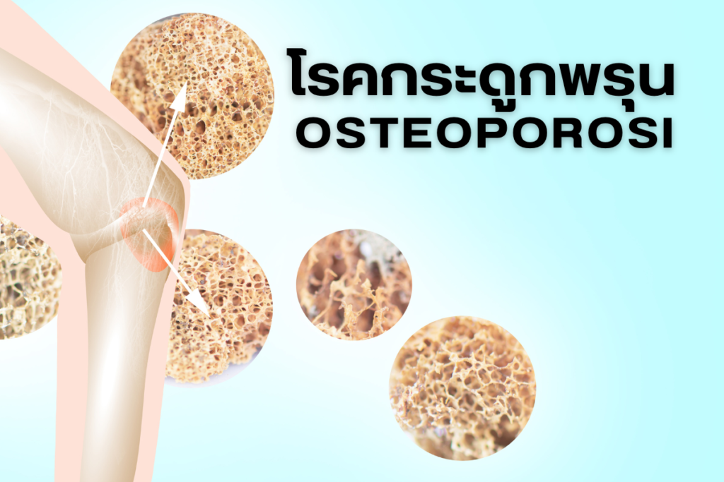 โรคกระดูกพรุน