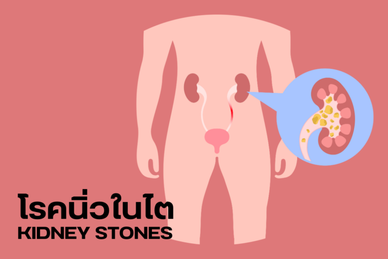 โรคนิ่วในไต