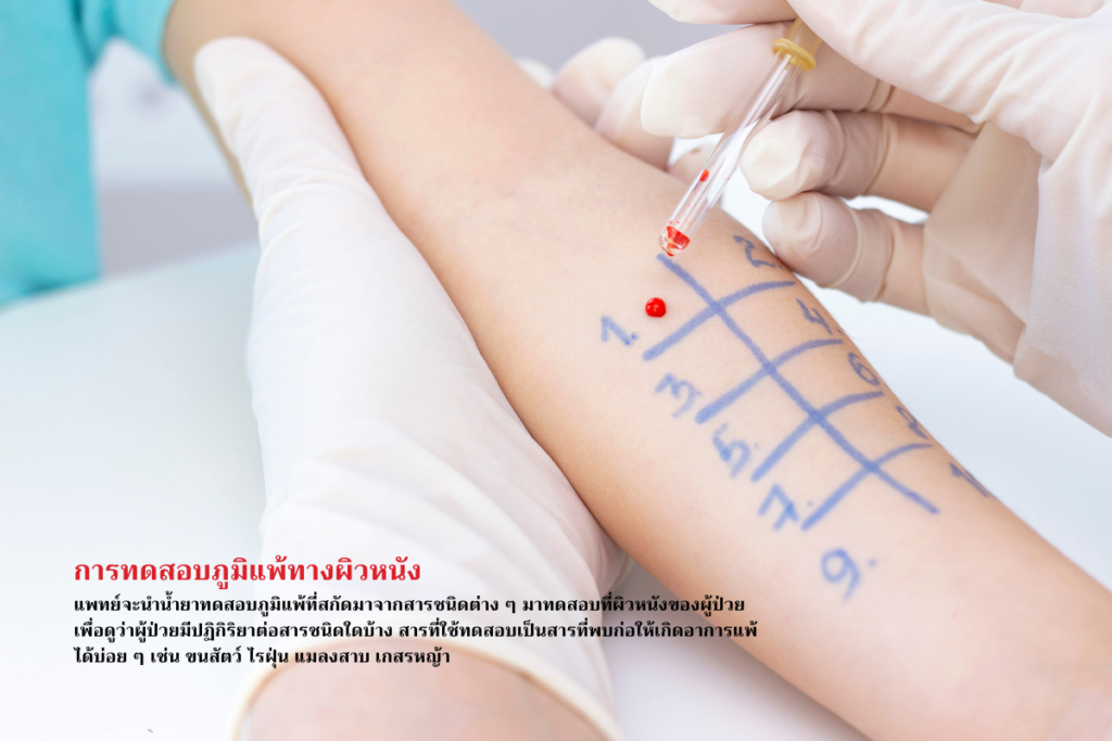 การทดสอบภูมิแพ้ทางผิวหนัง