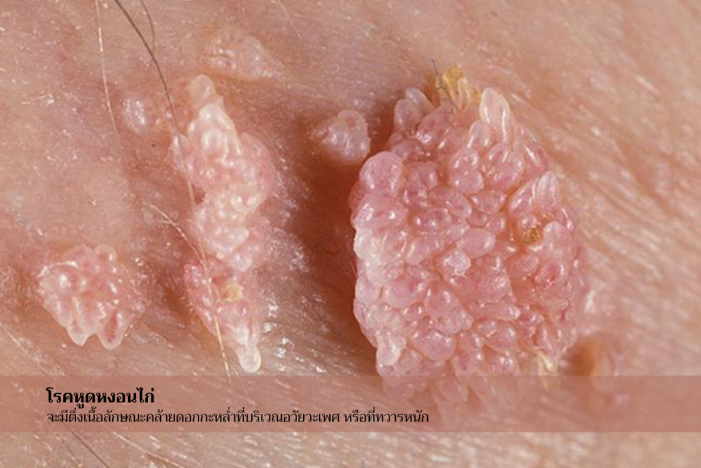 ลักษณะหูดหงอนไก่