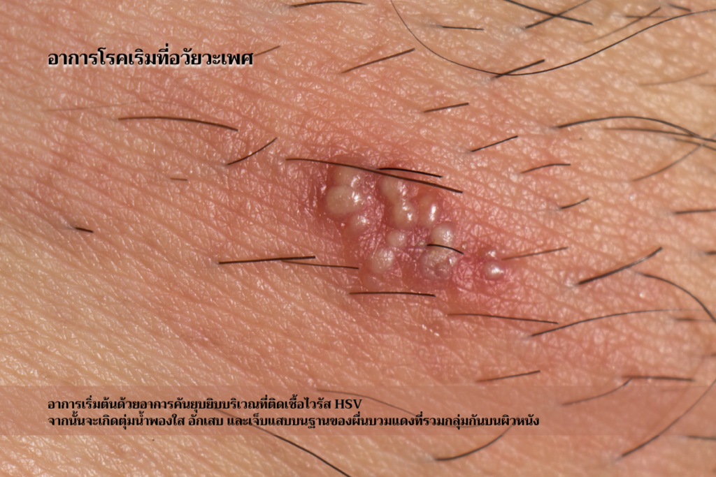 อาการโรคเริมที่อวัยวะเพศ