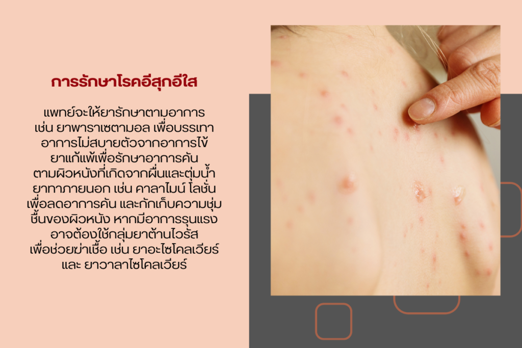 การรักษาโรคอีสุกอีใส