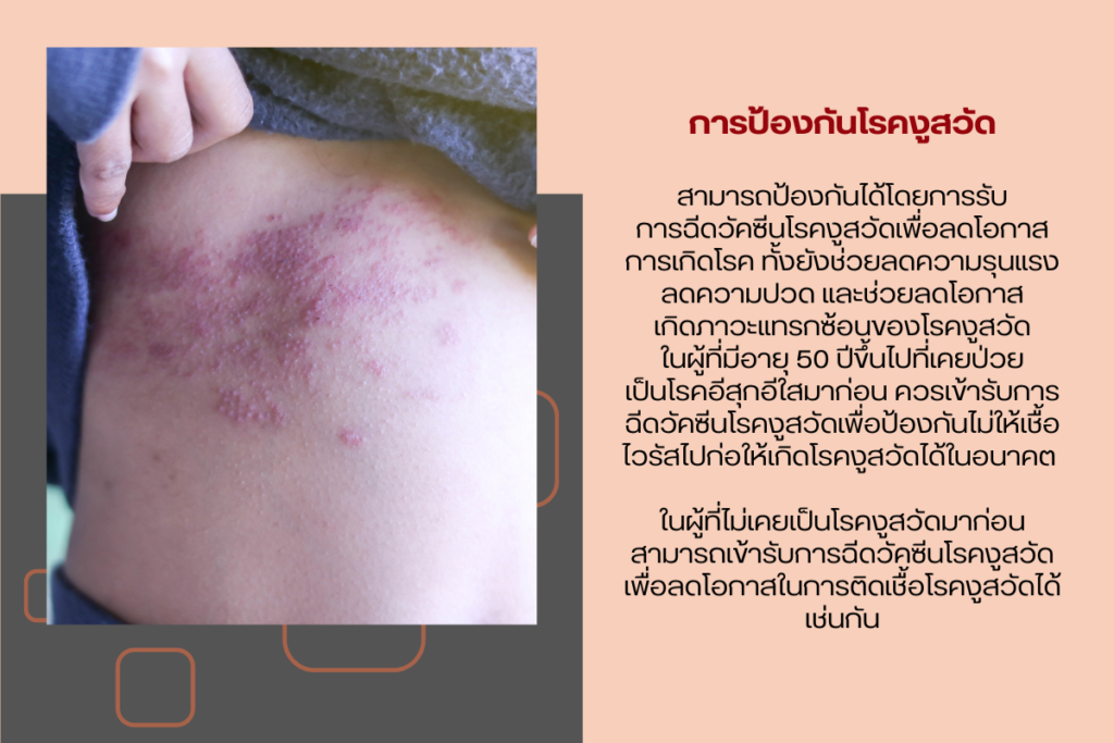 การป้องกันโรคงูสวัด