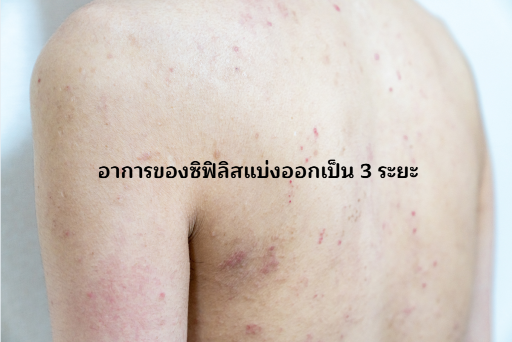 อาการของซิฟิลิสแบ่งออกเป็น 3 ระยะ
