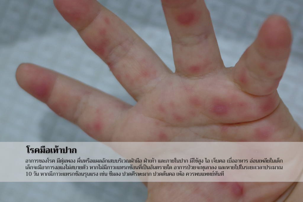 โรคมือเท้าปาก