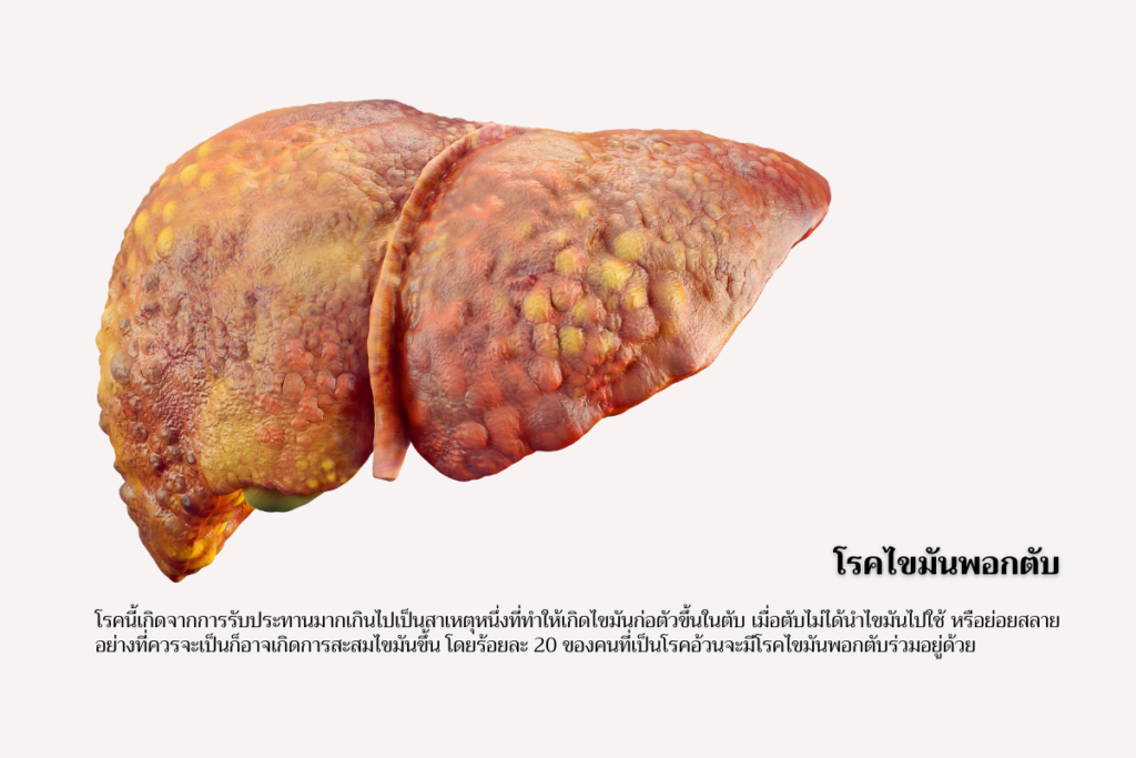 โรคอ้วน-โรคไขมันพอกตับ