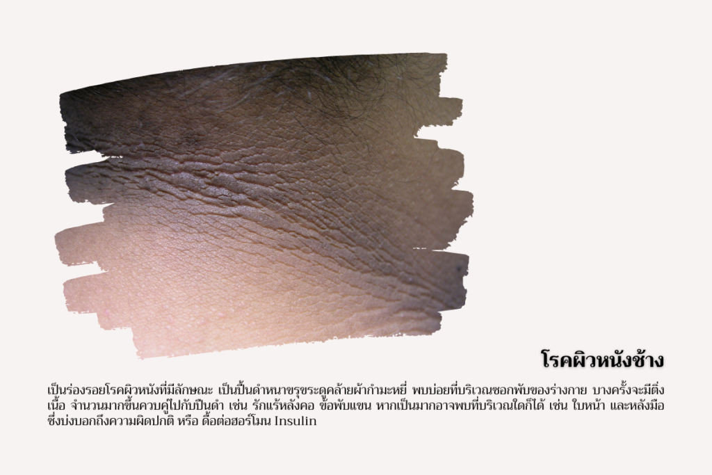 โรคอ้วน-โรคผิวหนังช้าง