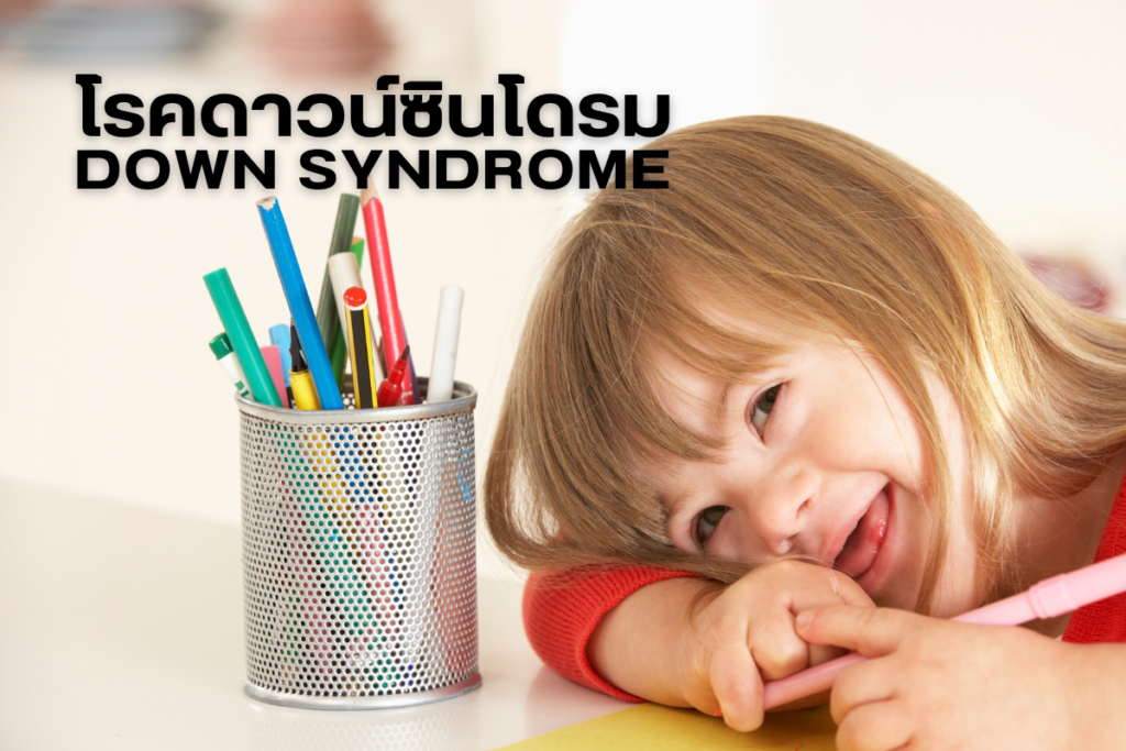 โรคดาวน์ซินโดรม