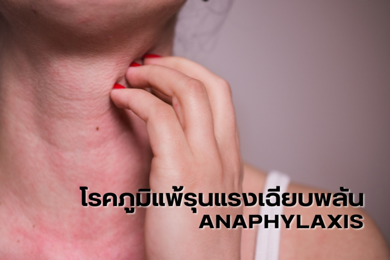 โรคภูมิแพ้รุนแรงเฉียบพลัน