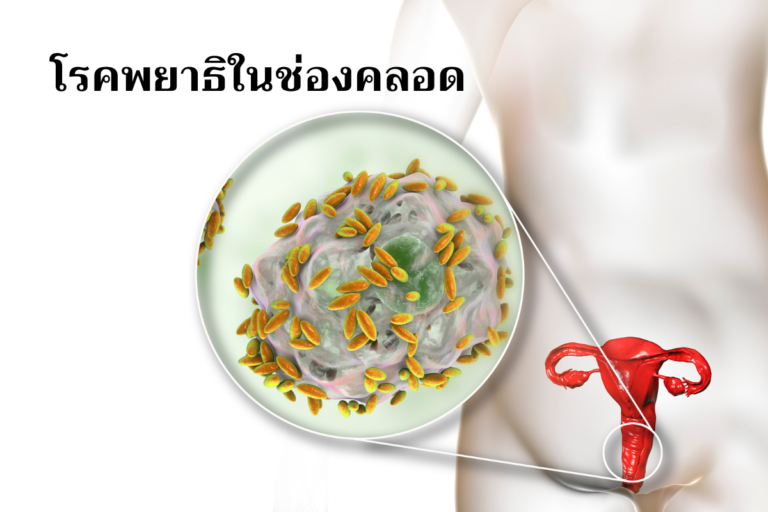 โรคพยาธิในช่องคลอด