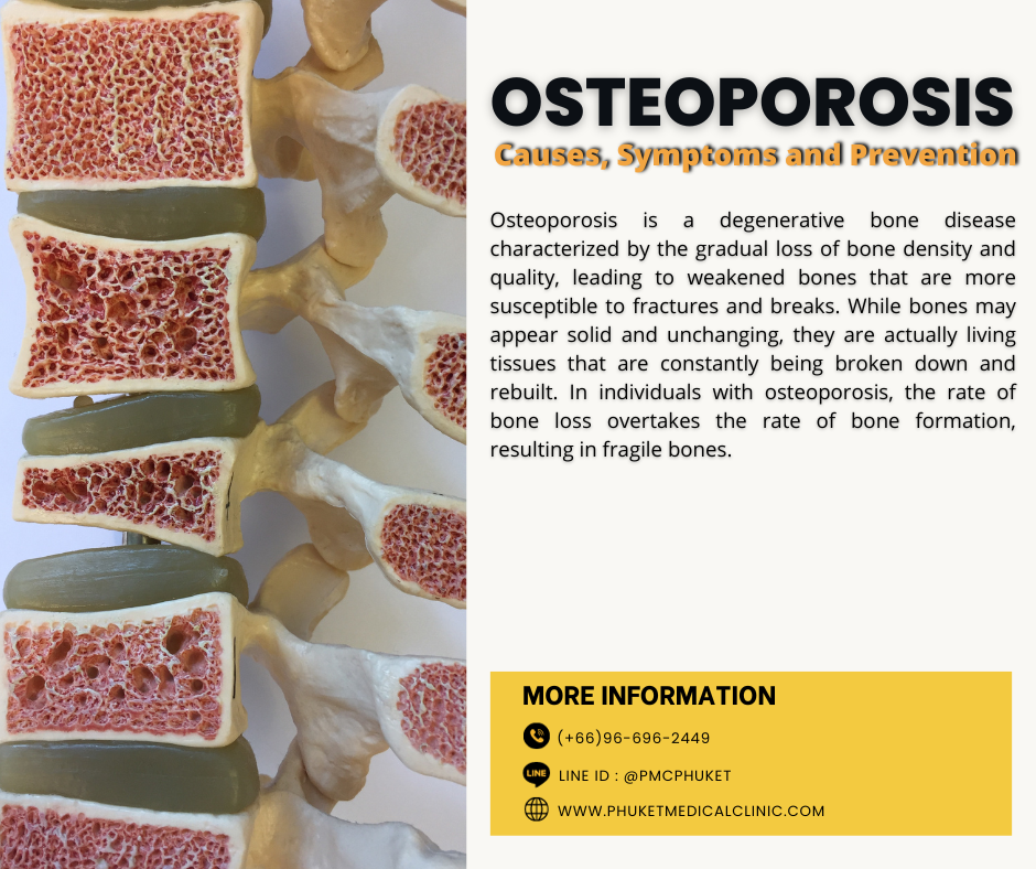 Osteoporosis Causes, Symptoms and Prevention