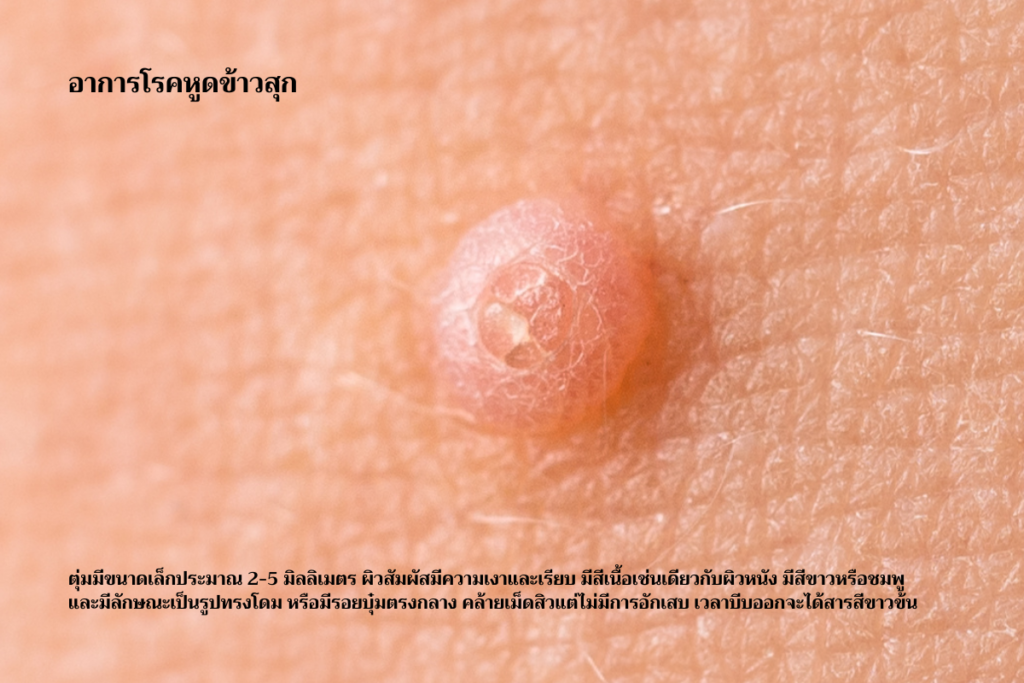 อาการโรคหูดข้าวสุก