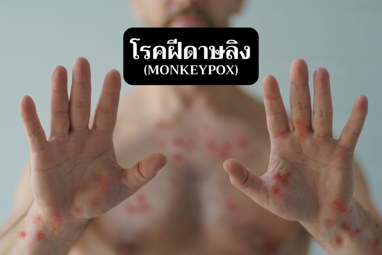 โรคฝีดาษลิง