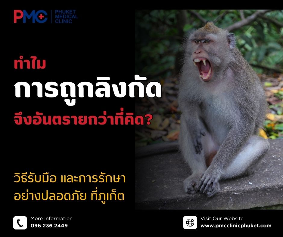 ทำไมการถูกลิงกัดจึงอันตรายกว่าที่คิด? วิธีรับมือและการรักษาอย่างปลอดภัย ที่ภูเก็ต