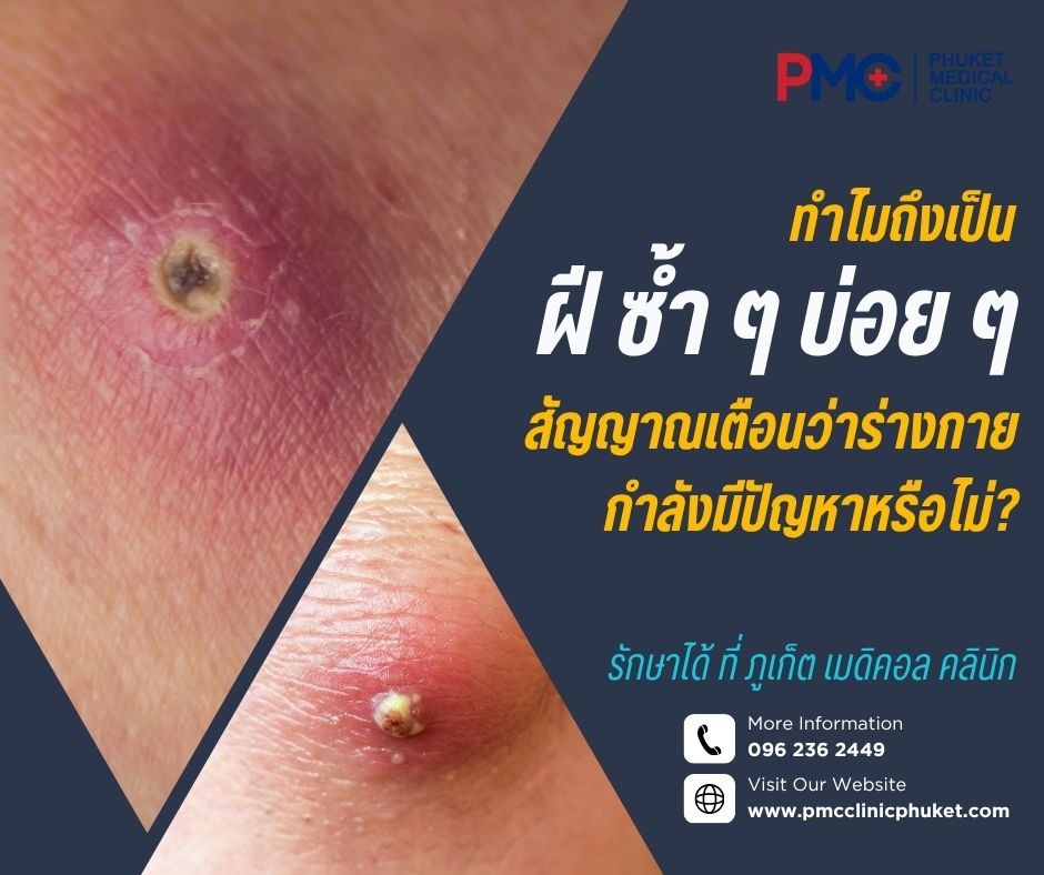 ทำไมถึงเป็นฝีซ้ำ ๆ บ่อย ๆ? สัญญาณเตือนว่าร่างกายกำลังมีปัญหาหรือไม่